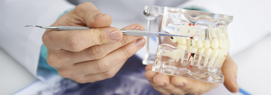Implantes dentales en Clínica dental Polident, Toledo