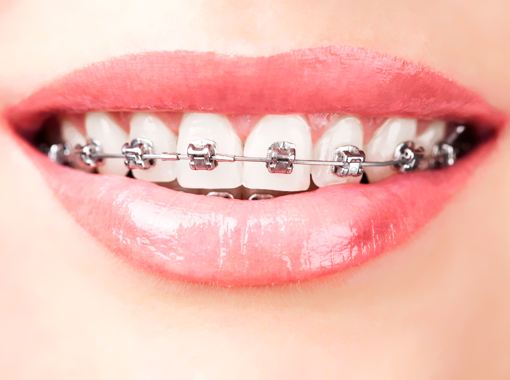 Ortodoncia invisible en Clínica dental Polident, Toledo