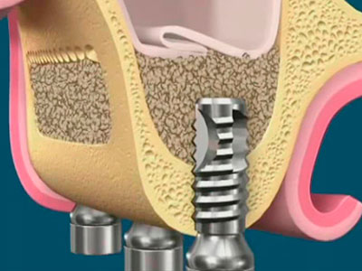 Elevación del seno maxilar para implantes dentales en Toledo