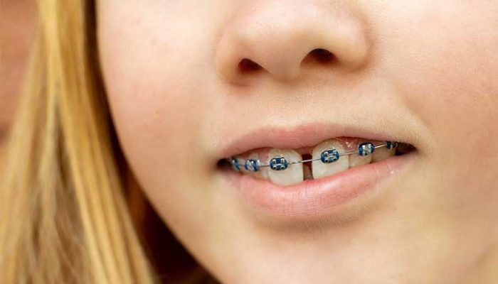 diastema dental