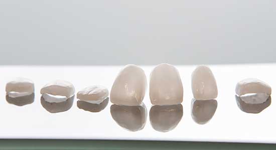 Carillas estéticas en Clínica dental Polident, Toledo
