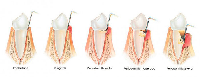 Gingivitis y enfermedades de las encías tratadas en Clínica dental Polident, Toledo