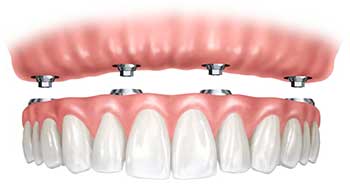 Prótesis fija sobre implantes en Clínica dental Polident, Toledo