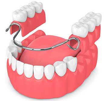 Prótesis removibles en Clínica dental Polident, Toledo