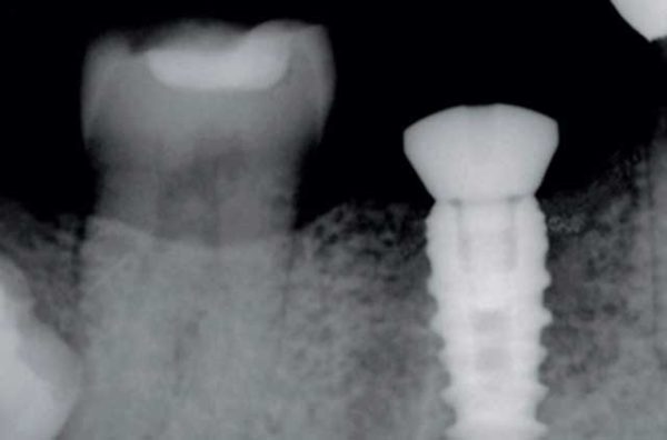 Radiografía intraoral digital en Clínica dental Polident, Toledo
