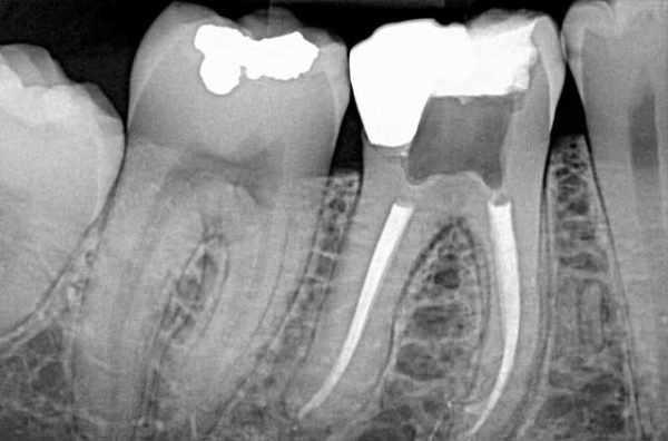 Radiografías periapicales digitales en Clínica dental Polident