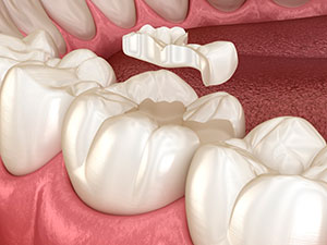 Incrustaciones dentales en Clínica dental Polident, Toledo