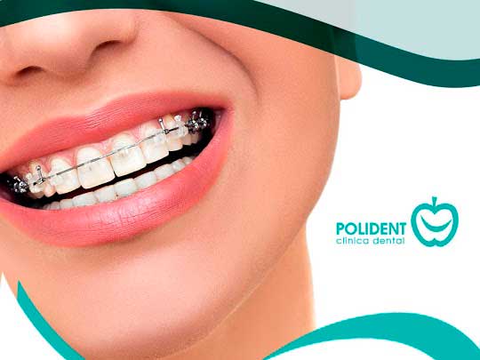 Tratamiento de ortodoncia en Clínica dental Polident, Toledo