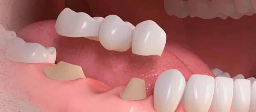 Prótesis dentales digitales, rápidas y excelentes