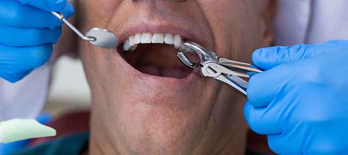 exodoncia o extracción dental clínica dental polident toledo