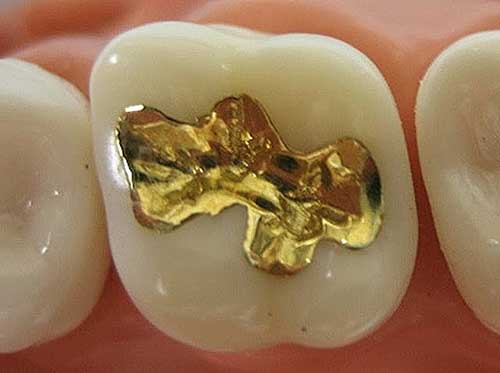 tipos de empastes dentales oro 
