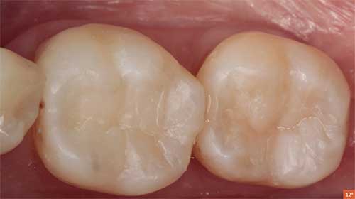 composites tipos de empastes dentales 