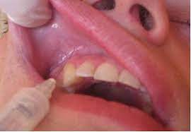 anestesia en odontología