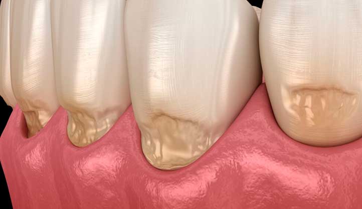 ¿Qué es la abfracción dental?