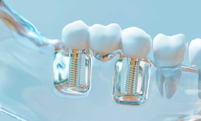 Síntomas de rechazo de los implantes dentales